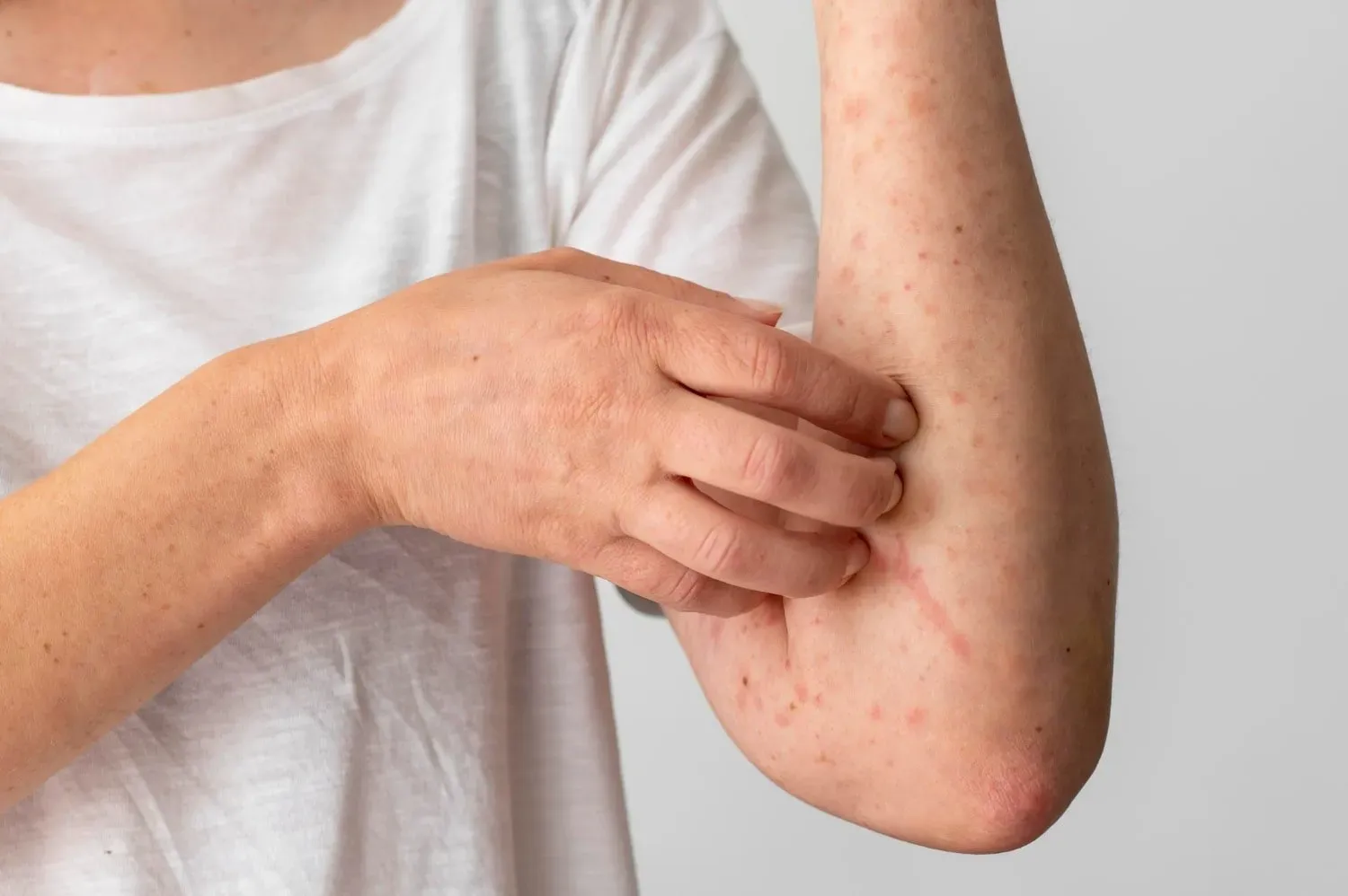 Symptoms-of-Skin-Allergy-and-Itc